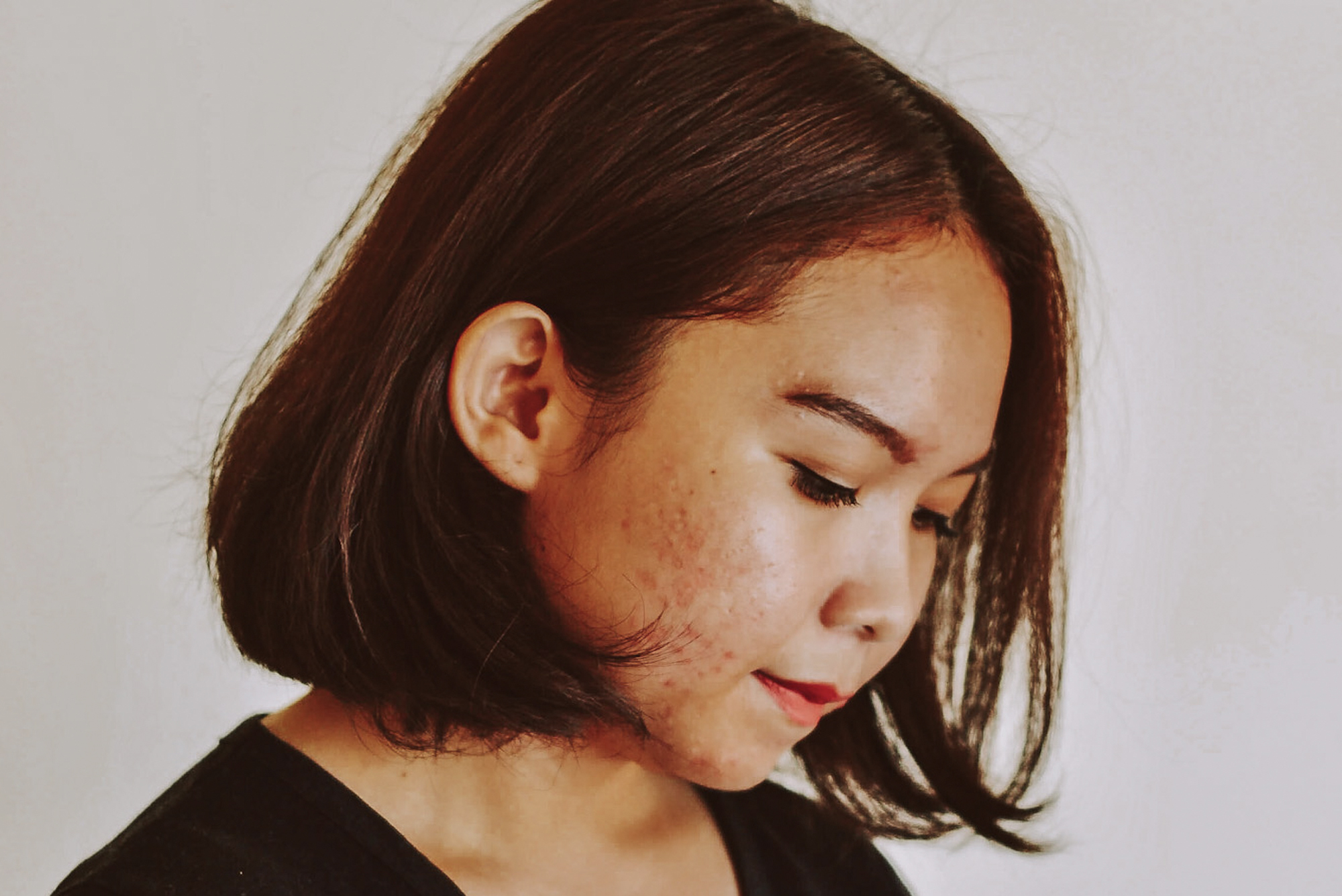 Les différents types d'acné de l'adulte et comment s'en débarrasser